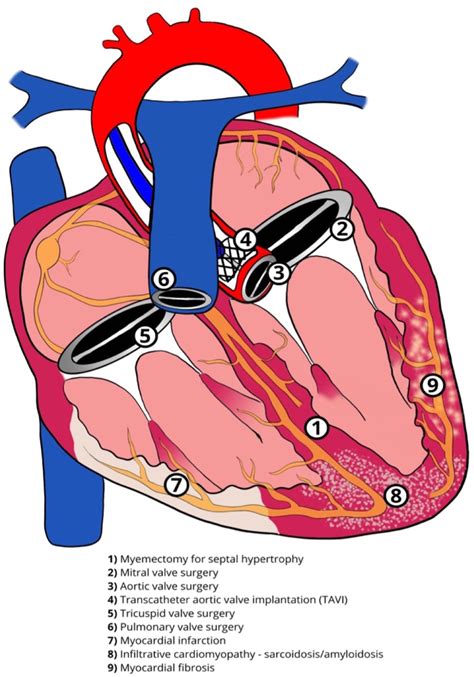 Image result for Cardiac Conduction System Disorders