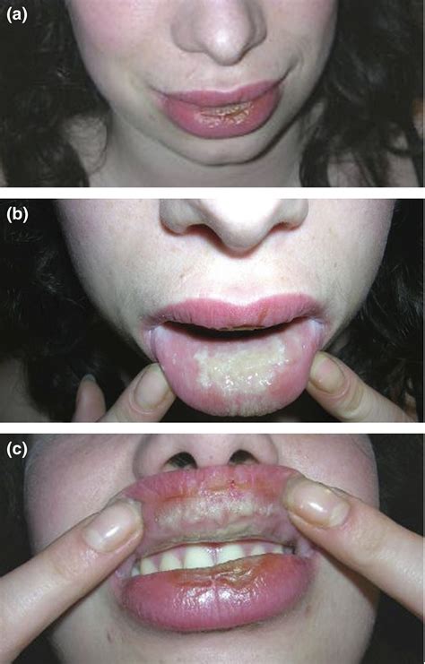What Causes Swollen Lips | Lipstutorial.org