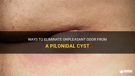 Ways To Eliminate Unpleasant Odor From A Pilonidal Cyst | MedShun