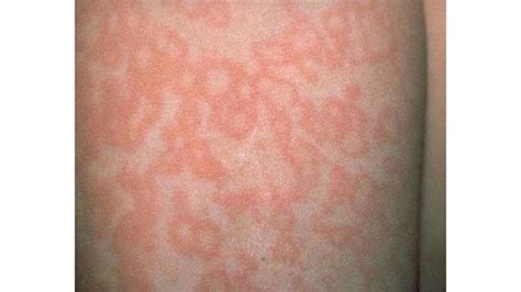 Fifth Disease (Erythema) facts every parent should know