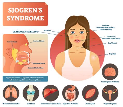 Sjogren's Syndrome Pronounce