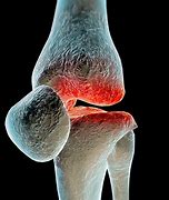 osteoarthritis 的图像结果
