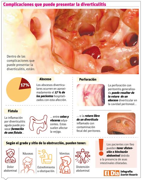 Síntomas y complicaciones de la diverticulitis, una enfermedad en el colon - Tour Atabex