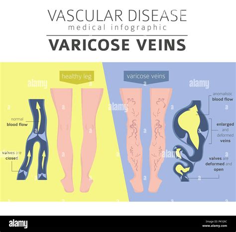 Vascular diseases. Varicose veins symptoms, treatment icon set. Medical infographic design ...