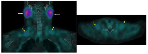 Imaging Metabolically Active Fat: A Literature Review and Mechanistic ...