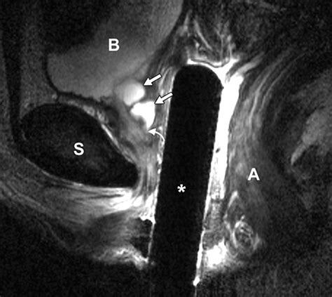 Urethral Diverticulum Mri EPOS™