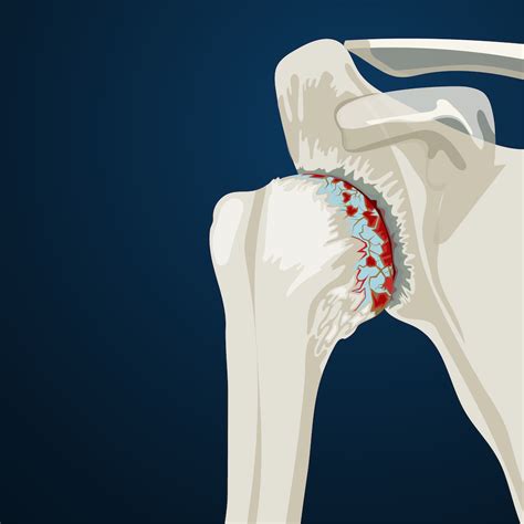 Shoulder Arthritis Signs, Symptoms & Surgery | Colorado Sports Doctor