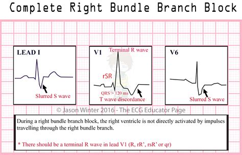 ECG Educator Blog : Bundle Branch Blocks