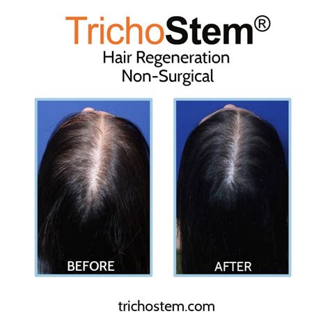 Understanding the Benefits and Risks of Finasteride in Women