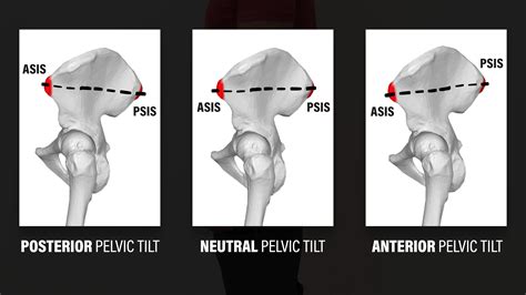 Perfect your posture! Anterior pelvic tilt is not a problem