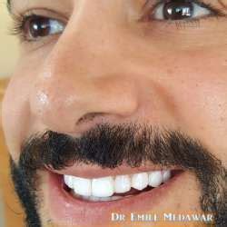 Direct Veneers Smile Lebanon | Composite Veneers Lebanon