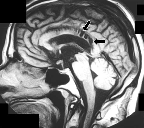 Lesions of the Corpus Callosum: MR Imaging and Differential Considerations in Adults and ...