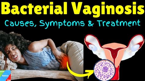 Bacterial Vaginosis (BV) - Symptoms, Causes, Diagnosis & Treatment ...