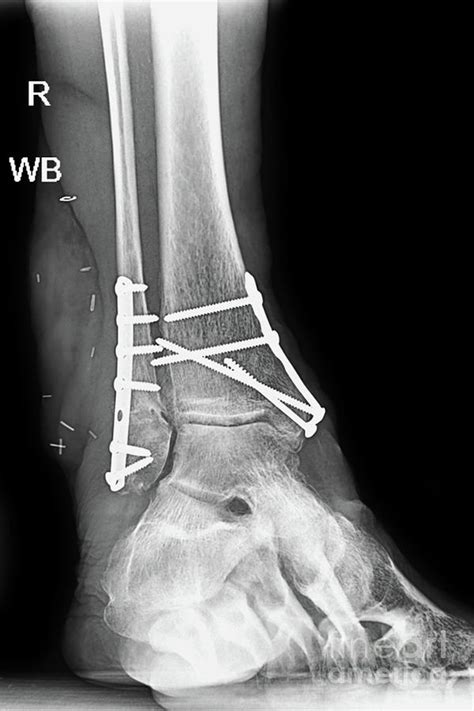 Ankle Fracture Metal Plates and Screws Photograph by Olga Hamilton