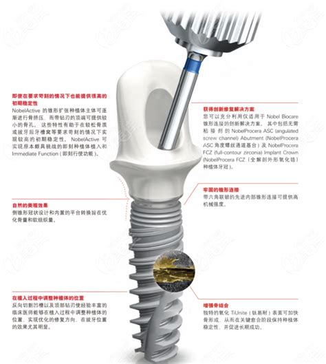 nobel种植牙_瑞典nobel种植牙价格_nobel种植牙系统_nobel种植牙的优缺点 - 开立特口腔