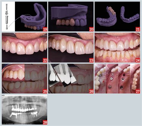 3 Unit Bridge Dental Bridge Medicare Dental Clinic