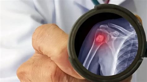 Best Health Insurance for Bone Cancer in India - Medical Cover for Bone ...