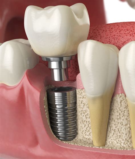 Restorative Dentistry: Renewing Smiles with Precision & Care