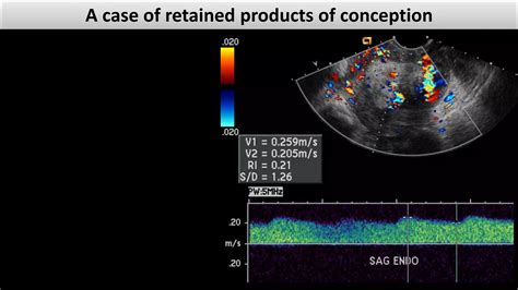 Retained products of conception dr.mohamed Soliman | PDF