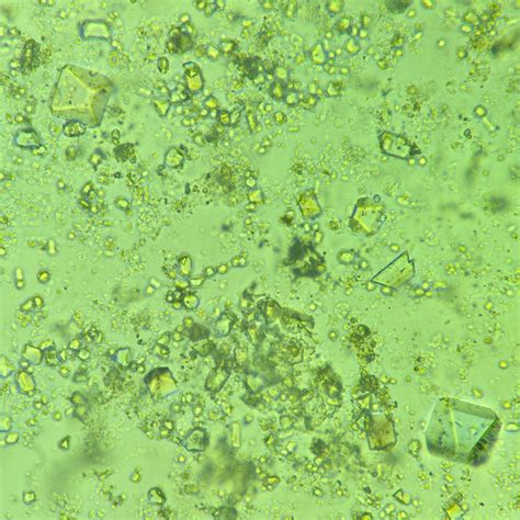 Triple Phosphate Crystals: Identification & Clinical Significance