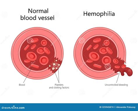 Normal Blood Vessel Hemophilia Comparison Diagram Stock Vector ...