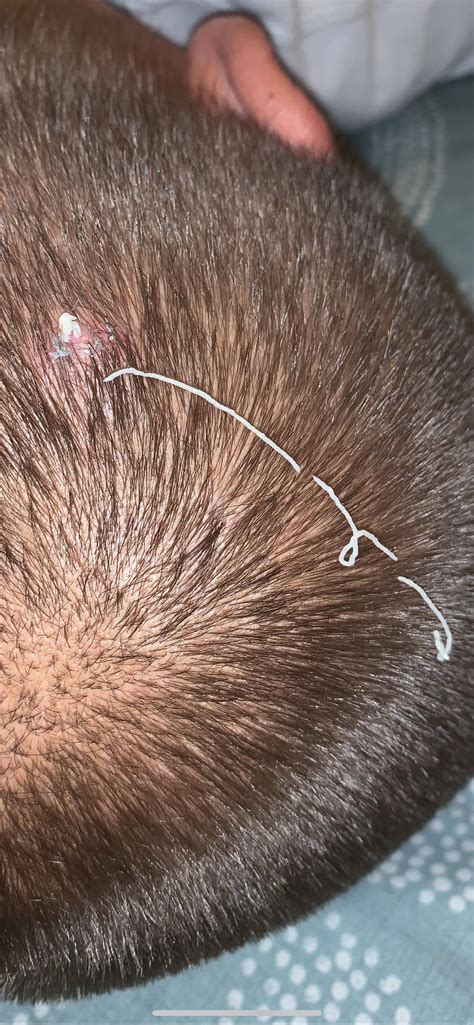 Boyfriend said that he felt like his Pilar cyst was ready to pop...I barely gave it a squeeze ...