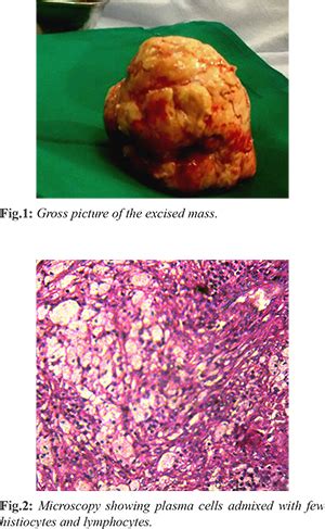 Inflammatory Psuedotumor of Lung as a Space-Occupying Lesion in the ...
