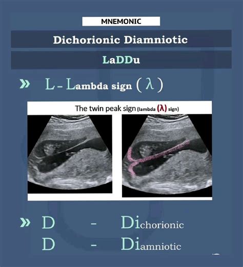 Lambda sign/Twin peak sign Mnemonic -"LADDU" in 2025 | Medical ...