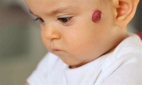Topical Timolol Found Safe and Well-Tolerated for Infantile Hemangioma ...