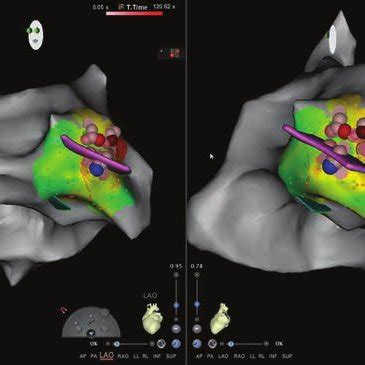 Image result for PVC Localization