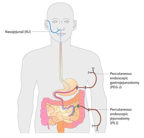 Percutaneous Gastrojejunostomy