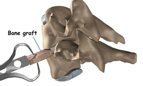 Spinal bone graft