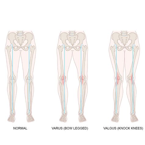 Hinged OA Unloader Knee Brace To Correct Varus or Valgus Deformity ...