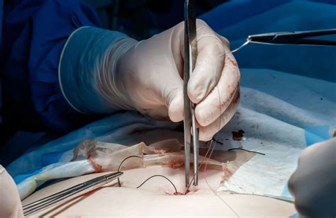 Usuwanie szwów ICD 10 | Najlepsza chińska fabryka szwów chirurgicznych