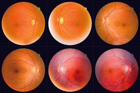 Retinal images can help early detection of Alzheimer's disease - CUHK ...