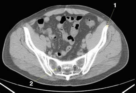 Image:Noncontrast CT Scan of the Abdomen and Pelvis Showing Normal ...