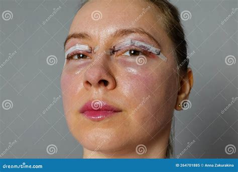 Woman Face after Plastic Surgery, Blepharoplasty Operation, Swelling Eye Bags, Incisions with ...