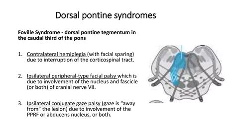 Anatomy of Pons | PPTX - hemorrhage in pons