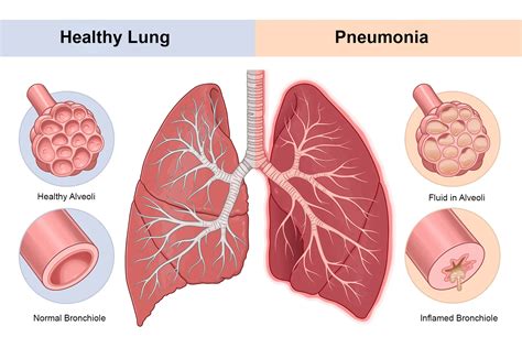 Pneumonia Virus Diagram