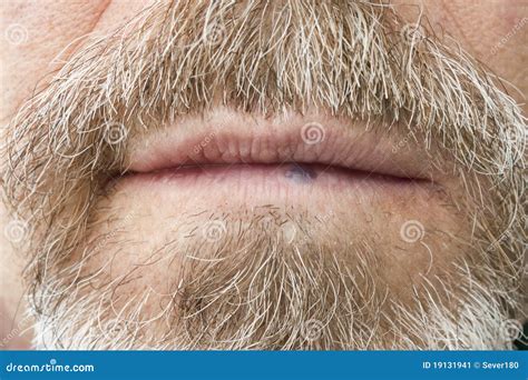 Hemangioma on the lip stock image. Image of sickness - 19131941