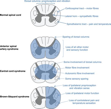 Anterior Cord Syndrome Defintion