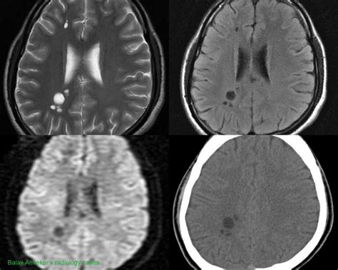 Perivascular Virchow Robin Space
