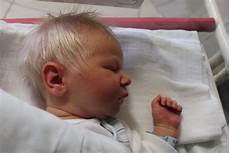 Newborn Without Hair by Baby Was Born With White Hair But When Doctors Reveal The Newborn Without Hair