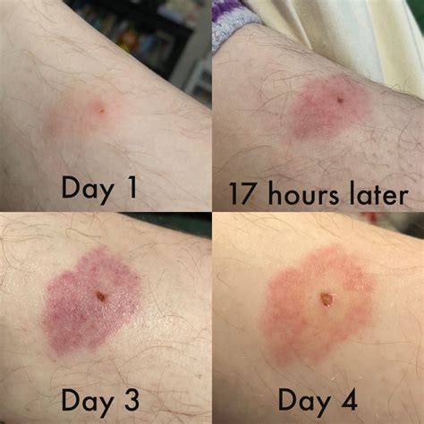 Does this look like a bullseye rash to anyone? I’m not really sure. : r/Lyme