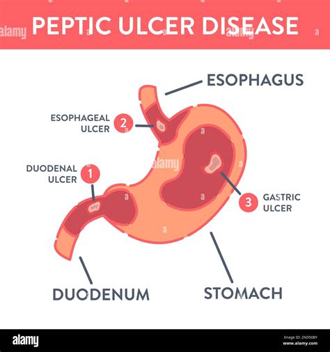 Medical infographics with types of peptic ulcer stomach disease Stock ...
