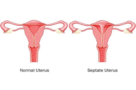 Septate Uterus: Types, Causes, Symptoms, Diagnosis, and Treatment