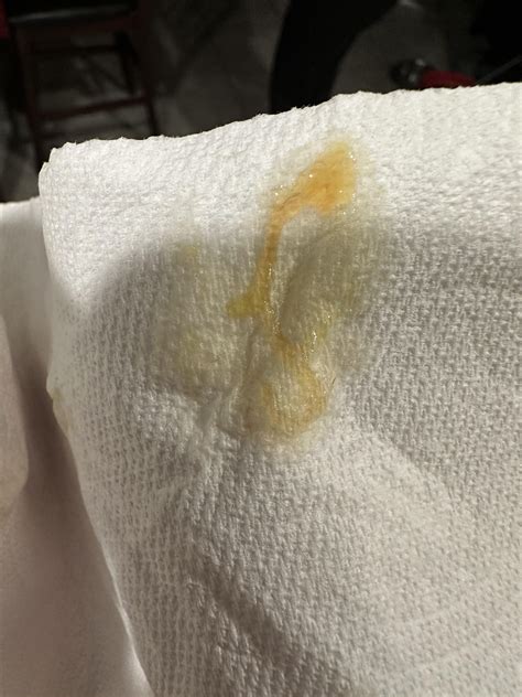 Yellow mucus from nose : r/Sinusitis