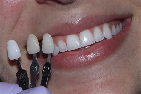 Process Of Veneers at Rachel Pak blog