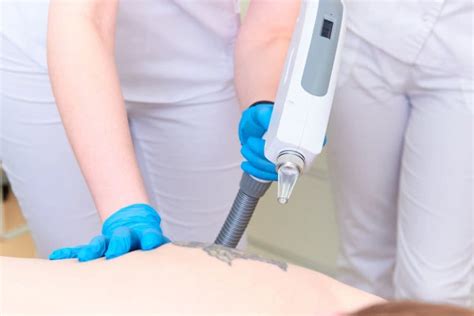 Tattoo Removal in HRBR Layout-Permanent Tattoo Removal