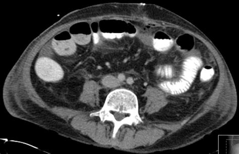 Bildergebnis für ruptured abscess on colon